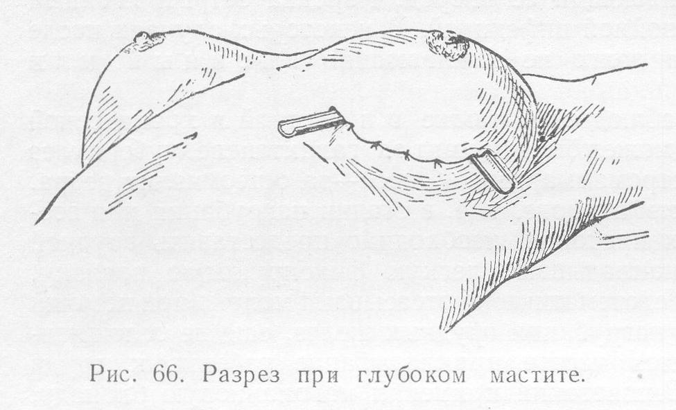 Схема хирургических разрезов при маститах